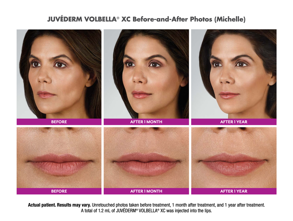 V-Day Special!  Purchase Juvéderm Volbella, Receive Complimentary 20 Units of Botox!